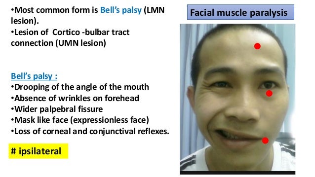 Masked facies but no facial paralysis Lesbain nurses in latex